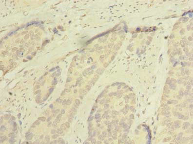 Immunohistochemistry of paraffin-embedded human gastric cancer using the antibody at dilution of 1:100Rabbit anti-Human SSMEM1 Polyclonal Antibody