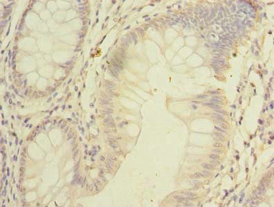 Immunohistochemistry of paraffin-embedded human colon cancer using SSMEM1 Antibody at dilution of 1:100Rabbit anti-Human SSMEM1 Polyclonal Antibody