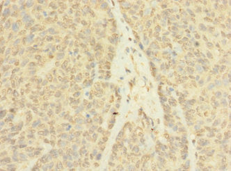 Immunohistochemistry of paraffin-embedded human ovarian cancer using ASZ1 Antibody at dilution of 1:100Rabbit anti-Human ASZ1 Polyclonal Antibody
