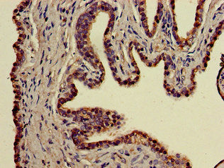 Immunohistochemistry of paraffin-embedded human prostate cancer using BBX Antibody at dilution of 1:100