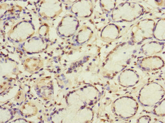 Immunohistochemistry of paraffin-embedded human gastric cancer using GBF1 Antibody at dilution of 1:100Rabbit anti-Human GBF1 Polyclonal Antibody