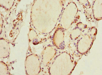 Immunohistochemistry of paraffin-embedded human thyroid tissue using THRSP Antibody at dilution of 1:100Rabbit anti-Human THRSP Polyclonal Antibody