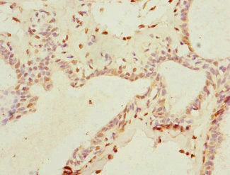 Immunohistochemistry of paraffin-embedded human breast cancer using THRSP Antibody at dilution of 1:100Rabbit anti-Human THRSP Polyclonal Antibody