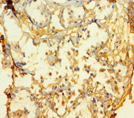 Immunohistochemistry of paraffin-embedded human breast cancer using ATOH1 Antibody at dilution of 1:100
