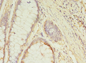 Immunohistochemistry of paraffin-embedded human colon cancer using GCC1 Antibody at dilution of 1:100Rabbit anti-Human GCC1 Polyclonal Antibody