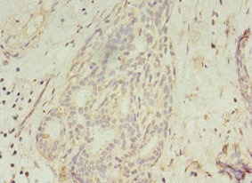 Immunohistochemistry of paraffin-embedded human breast cancer using GCC1 Antibody at dilution of 1:100Rabbit anti-Human GCC1 Polyclonal Antibody
