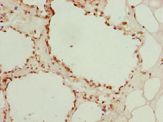 Immunohistochemistry of paraffin-embedded human breast cancer using LGALS12 Antibody at dilution of 1:100