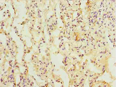 Immunohistochemistry of paraffin-embedded human lung cancer using L3HYPDH Antibody at dilution of 1:100