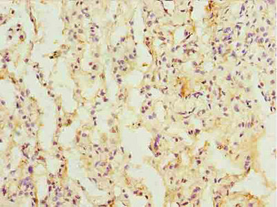 Immunohistochemistry of paraffin-embedded human lung cancer using L3HYPDH Antibody at dilution of 1:100
