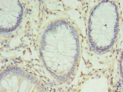 Immunohistochemistry of paraffin-embedded human colon cancer using CHMP6 Antibody at dilution of 1:100Rabbit anti-Human CHMP6 Polyclonal Antibody