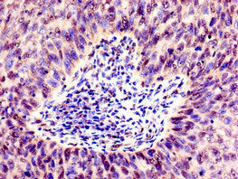 Immunohistochemistry of paraffin-embedded human cervical cancer using SMARCD1 Antibody at dilution of 1:100Rabbit anti-Human SMARCD1 Polyclonal Antibody