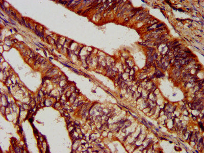 IHC image of SUCLG2 Antibody diluted at 1:300 and staining in paraffin-embedded human colon cancer performed on a Leica BondTM system. After dewaxing and hydration, antigen retrieval was mediated by high pressure in a citrate buffer (pH 6.0). Section was blocked with 10% normal goat serum 30min at RT. Then primary antibody (1% BSA) was incubated at 4°C overnight. The primary is detected by a biotinylated secondary antibody and visualized using an HRP conjugated SP system.Rabbit anti-Human SUCLG2 Polyclonal Antibody