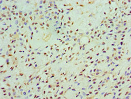 Immunohistochemistry of paraffin-embedded human breast cancer using CAMK1G Antibody at dilution of 1:100Rabbit anti-Human CAMK1G Polyclonal Antibody