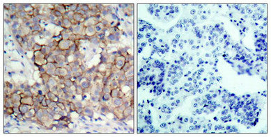 Immunohistochemical analysis of paraffin-embedded human breast carcinoma tissue, using HER2(Phospho-Tyr877) Antibody(left) or the same antibody preincubated with blocking peptide(right).Rabbit anti-Human ERBB2 Polyclonal Antibody
