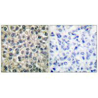 Immunohistochemical analysis of paraffin-embedded human breast carcinoma tissue using Catenin-γ antibody.