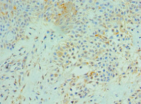 Immunohistochemistry of paraffin-embedded human breast cancer using the antibody at dilution of 1:100Rabbit anti-Human SRPK1 Polyclonal Antibody