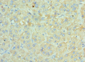 Immunohistochemistry of paraffin-embedded human liver cancer using SRPK1 Antibody at dilution of 1:100Rabbit anti-Human SRPK1 Polyclonal Antibody