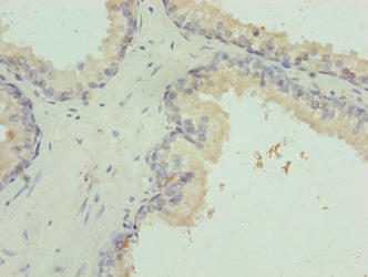 Immunohistochemistry of paraffin-embedded human prostate cancer using INTS14 Antibody at dilution of 1:100