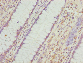 Immunohistochemistry of paraffin-embedded human colon cancer using INTS14 Antibody at dilution of 1:100