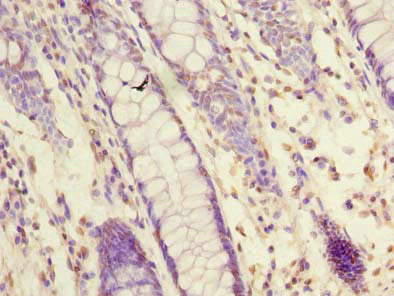 Immunohistochemistry of paraffin-embedded human colon cancer using NXPE1 Antibody at dilution of 1:100Rabbit anti-Human NXPE1 Polyclonal Antibody