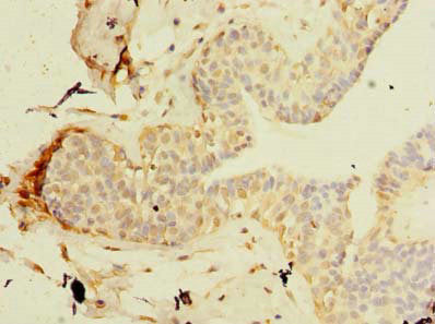 Immunohistochemistry of paraffin-embedded human breast cancer using TCP11L2 Antibody at dilution of 1:100Rabbit anti-Human TCP11L2 Polyclonal Antibody