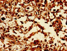 Immunohistochemistry of paraffin-embedded human melanoma using CERS5 Antibody at dilution of 1:100Rabbit anti-Human CERS5 Polyclonal Antibody