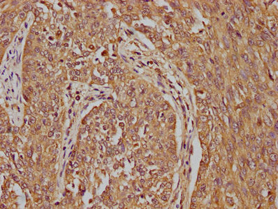 IHC image of LRTM2 Antibody diluted at 1:100 and staining in paraffin-embedded human cervical cancer performed on a Leica BondTM system. After dewaxing and hydration, antigen retrieval was mediated by high pressure in a citrate buffer (pH 6.0). Section was blocked with 10% normal goat serum 30min at RT. Then primary antibody (1% BSA) was incubated at 4°C overnight. The primary is detected by a biotinylated secondary antibody and visualized using an HRP conjugated SP system.