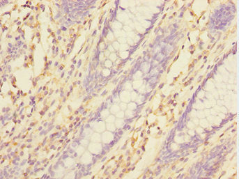 Immunohistochemistry of paraffin-embedded human colon cancer using TXNDC5 Antibody at dilution of 1:100Rabbit anti-Human TXNDC5 Polyclonal Antibody