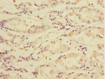Immunohistochemistry of paraffin-embedded human gastric cancer using TXNDC5 Antibody at dilution of 1:100Rabbit anti-Human TXNDC5 Polyclonal Antibody