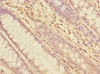 Immunohistochemistry of paraffin-embedded human colon cancer using TXNDC5 Antibody at dilution of 1:100Rabbit anti-Human TXNDC5 Polyclonal Antibody