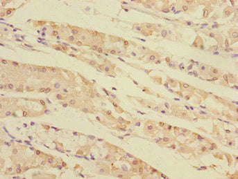 Immunohistochemistry of paraffin-embedded human gastric cancer using TXNDC5 Antibody at dilution of 1:100Rabbit anti-Human TXNDC5 Polyclonal Antibody