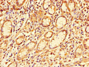 Immunohistochemistry of paraffin-embedded human gastric cancer using the antibody at dilution of 1:100Rabbit anti-Human GALNT11 Polyclonal Antibody