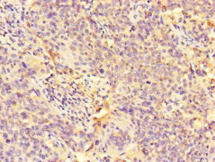 Immunohistochemistry of paraffin-embedded human cervical cancer using GALNT11 Antibody at dilution of 1:100Rabbit anti-Human GALNT11 Polyclonal Antibody