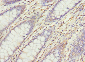 Immunohistochemistry of paraffin-embedded human colon cancer using VANGL1 Antibody at dilution of 1:100Rabbit anti-Human VANGL1 Polyclonal Antibody