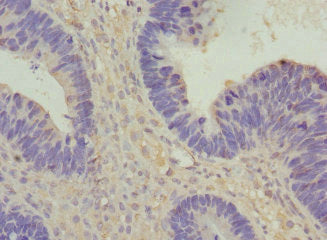 Immunohistochemistry of paraffin-embedded human ovarian cancer using VANGL1 Antibody at dilution of 1:100Rabbit anti-Human VANGL1 Polyclonal Antibody