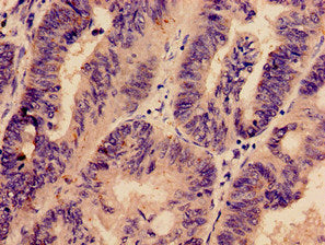 Immunohistochemistry analysis of human colon cancer using the antibody at dilution of 1:100
