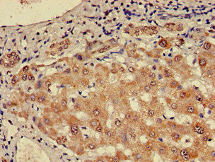 Immunohistochemistry of paraffin-embedded human liver cancer using the antibody at dilution of 1:100