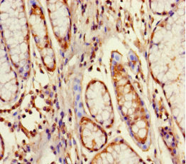 Immunohistochemistry of paraffin-embedded human gastric cancer using GPX8 Antibody at dilution of 1:100Rabbit anti-Human GPX8 Polyclonal Antibody