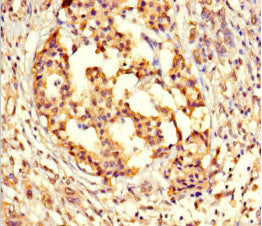 Immunohistochemistry of paraffin-embedded human pancreatic cancer using GPX8 Antibody at dilution of 1:100Rabbit anti-Human GPX8 Polyclonal Antibody