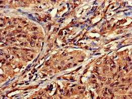 Immunohistochemistry of paraffin-embedded human lung cancer using DOT1L Antibody at dilution of 1:100Rabbit anti-Human DOT1L Polyclonal Antibody