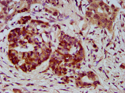 IHC image of NEU4 Antibody diluted at 1:400 and staining in paraffin-embedded human pancreatic cancer performed on a Leica BondTM system. After dewaxing and hydration, antigen retrieval was mediated by high pressure in a citrate buffer (pH 6.0). Section was blocked with 10% normal goat serum 30min at RT. Then primary antibody (1% BSA) was incubated at 4°C overnight. The primary is detected by a biotinylated secondary antibody and visualized using an HRP conjugated SP system.Rabbit anti-Human NEU4 Polyclonal Antibody