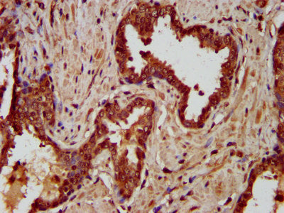 IHC image of the antibody diluted at 1:200 and staining in paraffin-embedded human prostate cancer performed on a Leica BondTM system. After dewaxing and hydration, antigen retrieval was mediated by high pressure in a citrate buffer (pH 6.0). Section was blocked with 10% normal goat serum 30min at RT. Then primary antibody (1% BSA) was incubated at 4°C overnight. The primary is detected by a biotinylated secondary antibody and visualized using an HRP conjugated SP system.
