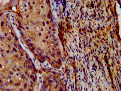 IHC image of LIPH Antibody diluted at 1:200 and staining in paraffin-embedded human lung cancer performed on a Leica BondTM system. After dewaxing and hydration, antigen retrieval was mediated by high pressure in a citrate buffer (pH 6.0). Section was blocked with 10% normal goat serum 30min at RT. Then primary antibody (1% BSA) was incubated at 4°C overnight. The primary is detected by a biotinylated secondary antibody and visualized using an HRP conjugated SP system.