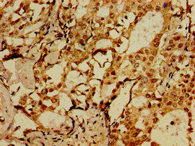 Immunohistochemistry of paraffin-embedded human breast cancer using SORCS1 Antibody at dilution of 1:100Rabbit anti-Human SORCS1 Polyclonal Antibody