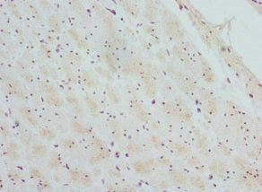 Immunohistochemistry of paraffin-embedded human colon cancer using CTNNBL1 Antibody at dilution of 1:100Rabbit anti-Human CTNNBL1 Polyclonal Antibody