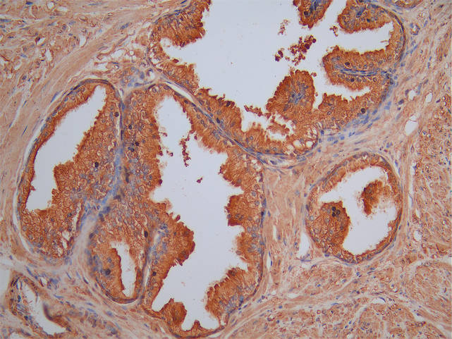 IHC image of SLC7A6 Antibody diluted at 1:100 and staining in paraffin-embedded human prostate cancer performed on a Leica BondTM system. After dewaxing and hydration, antigen retrieval was mediated by high pressure in a citrate buffer (pH 6.0). Section was blocked with 10% normal goat serum 30min at RT. Then primary antibody (1% BSA) was incubated at 4°C overnight. The primary is detected by a Goat anti-rabbit polymer IgG labeled by HRP and visualized using 0.05% DAB.Rabbit anti-Human SLC7A6 Polyclonal Antibody