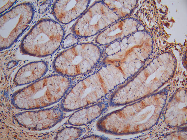 IHC image of SLC7A6 Antibody diluted at 1:100 and staining in paraffin-embedded human colorectal cancer performed on a Leica BondTM system. After dewaxing and hydration, antigen retrieval was mediated by high pressure in a citrate buffer (pH 6.0). Section was blocked with 10% normal goat serum 30min at RT. Then primary antibody (1% BSA) was incubated at 4°C overnight. The primary is detected by a Goat anti-rabbit polymer IgG labeled by HRP and visualized using 0.05% DAB.Rabbit anti-Human SLC7A6 Polyclonal Antibody