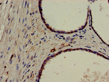 Immunohistochemistry of paraffin-embedded human prostate cancer using ERCC4 Antibody at dilution of 1:100Rabbit anti-Human ERCC4 Polyclonal Antibody