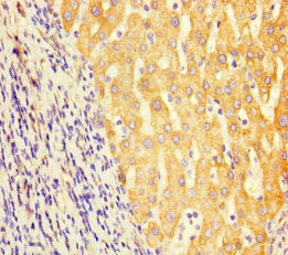 Immunohistochemistry of paraffin-embedded human liver cancer using GCDH Antibody at dilution of 1:100Rabbit anti-Human GCDH Polyclonal Antibody