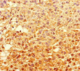 Immunohistochemistry of paraffin-embedded human melanoma using GCDH Antibody at dilution of 1:100Rabbit anti-Human GCDH Polyclonal Antibody